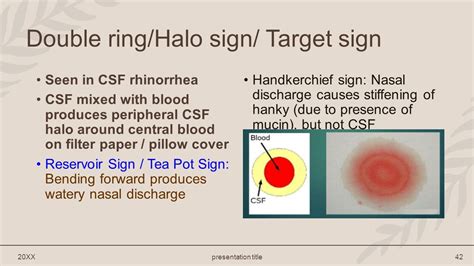 halo sign csf|Halo sign